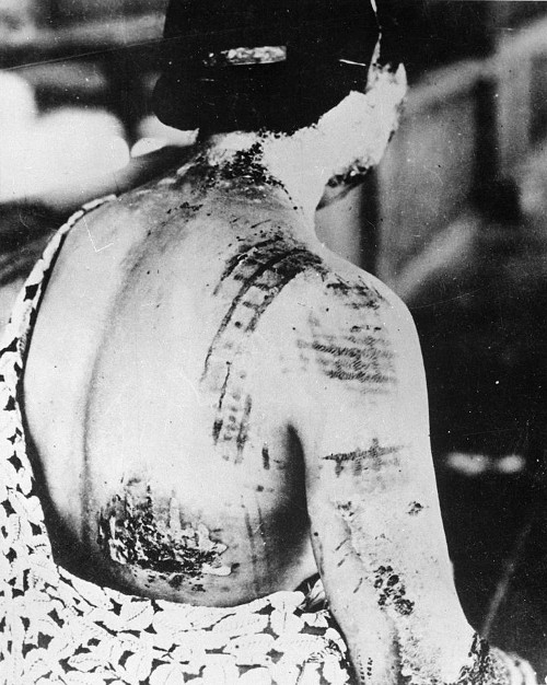 The patient's skin is burned in a pattern corresponding to the dark portions of a kimono.