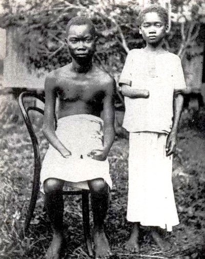 Congolese whose hands were chopped off by colonialists