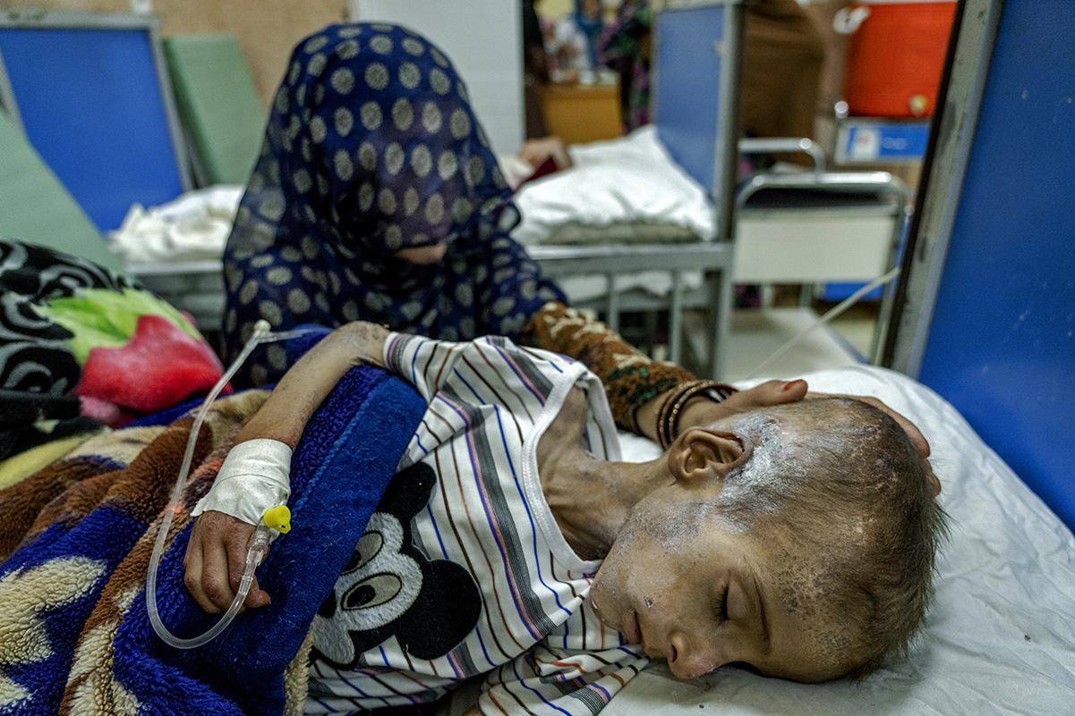 Afghan mother with her starving son in a hospital in Kabul, May 25, 2022.