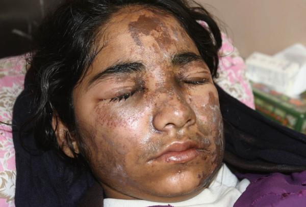 17 year old victim of an acid attack in Afghanistan
