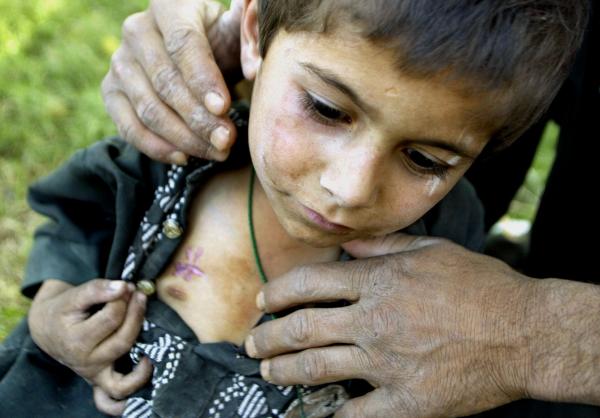 Afghani boy shows scars from shrapnel. wounds U.S. bombing