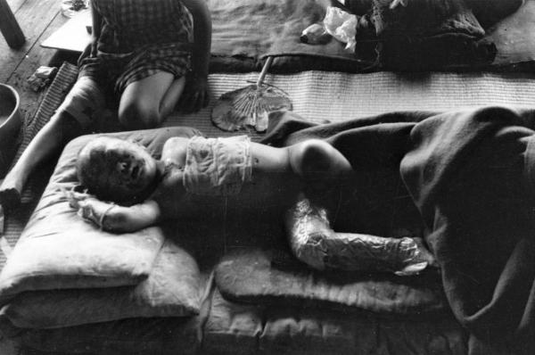 Body of a child burned by nuclear bomb dropped on Hiroshima.