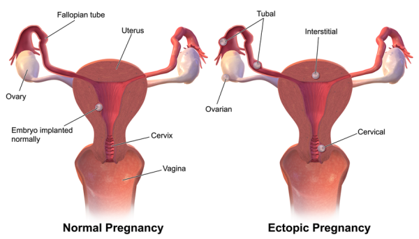 Graphic of uterus, fallopian tubes, in normal pregnancy; also uterus, fallopian tubes, and ectopic pregnancy.
