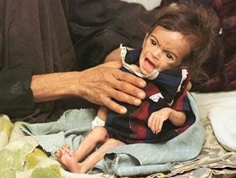 Iraqi child suffering malnutrition due to UN sanctions.
