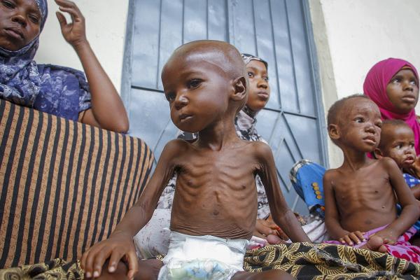 Malnourished two-year-old in Somalia where worst drought in decades has contributed to more than 450 deaths this year so far. 