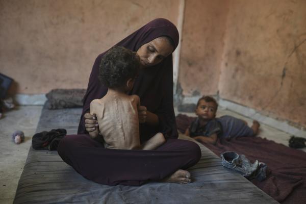 Palestinian mother holds her 2-year-old badly malnourished daughter, July 23, 2025.