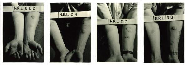 Forearms of human test subjects after being exposed to nitrogen mustard and lewisite agents.