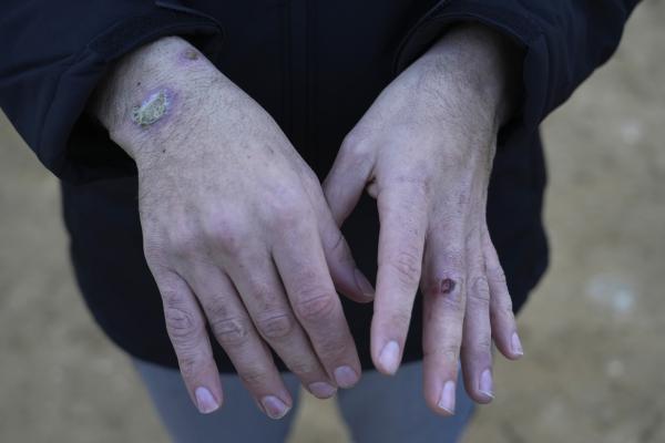 Palestinian prisoner shows wounds on his hands after his release on February 27, 2025.